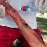 Burn Injuries –Seeking Compensation through Premises Liability